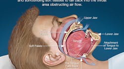 Obstructive sleep apnea: During sleep, gravity and muscle relaxation allows the tongue and surrounding tissues to fall back into the throat area obstructing air flow. Photo courtesy of Dear Doctor Inc.